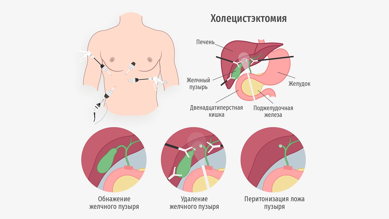 воспаление желчного пузыря лечение на дому (100) фото